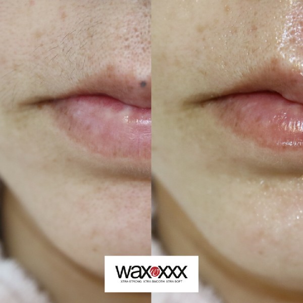 フェイシャルワックスで口周りの産毛をケアしたビフォーアフター写真。施術後はつるんとした明るい肌へ。