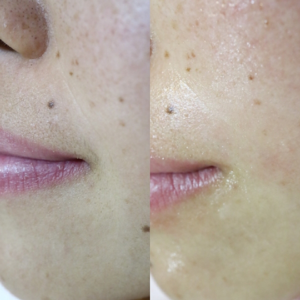 フェイシャルワックスで産毛と角質を除去し、透明感のある明るい肌に仕上がった30代女性の写真。