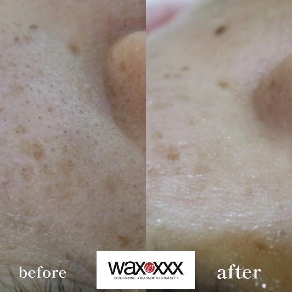 冬の乾燥でくすんだ肌が明るく整ったフェイシャルワックス施術後の30代後半の女性