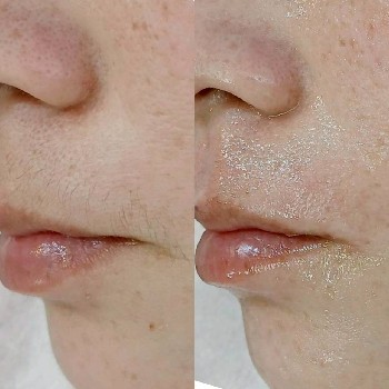 フェイシャルワックス施術後の肌。産毛と角質が整い、季節の変わり目でも明るくなめらかな印象の口元。