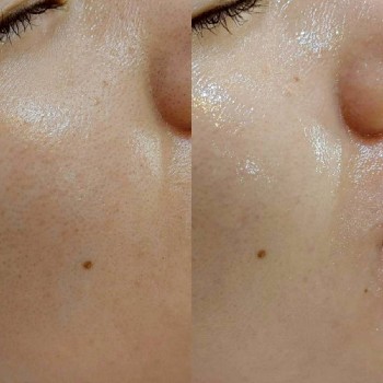 30代女性のお顔ワックス施術前後の比較写真。頬の産毛を整えたことで、お肌がなめらかになり、明るくすっきりとした印象になっている。