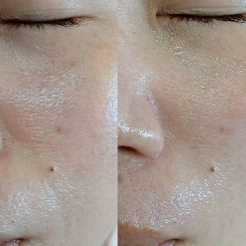 お顔のワックス施術前後の比較写真。頬や口もtの産毛を整え、お肌がなめらかで、お顔全体がすっきりとした印象に見える様子。