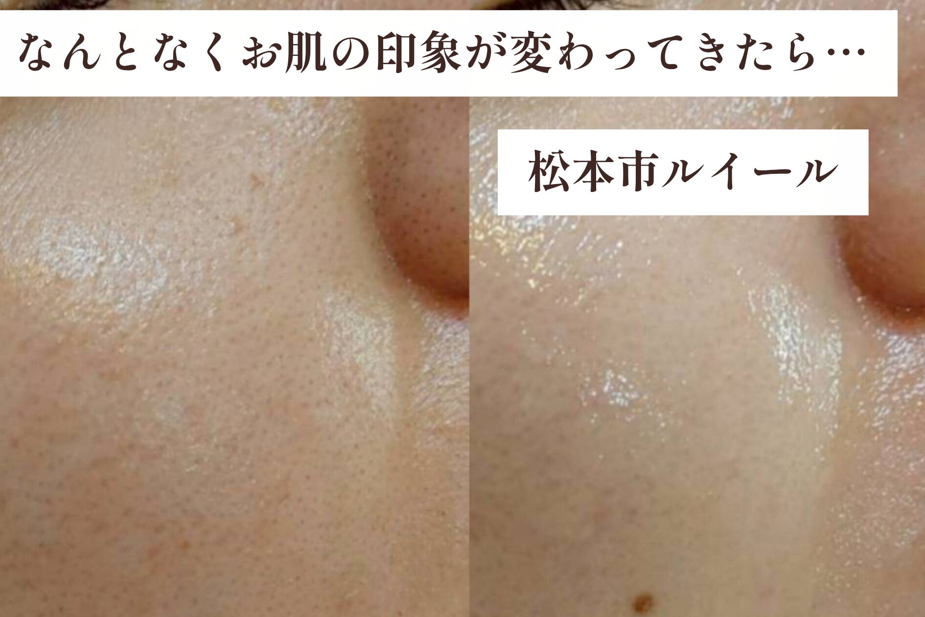 お顔のワックスの後に気をつけたいこと|きれいなお肌を保つために【松本市マツエク&まつげカール専門店LUIRE(ルイール)】