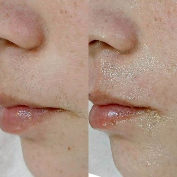 フェイシャルワックス施術前後の比較写真。産毛を整えることで、お肌がなめらかで明るい印象に見える様子。
