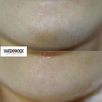 お顔のワックスごの施術前後の比較写真。顎周りがすっきりして、明るい肌印象に。